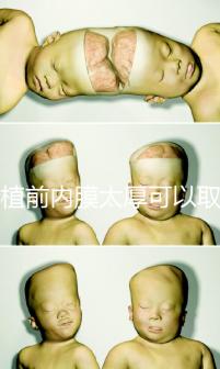 移植前內膜太厚可以取卵早知道，疼痛因人而異