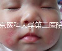 北京醫(yī)科大學(xué)第三醫(yī)院nt檢查費(fèi)用盤(pán)點(diǎn)需要多長(zhǎng)時(shí)間，是否預(yù)約