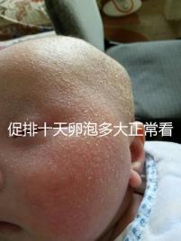 促排十天卵泡多大正常看這,1.1×0.9符不符合一文說清