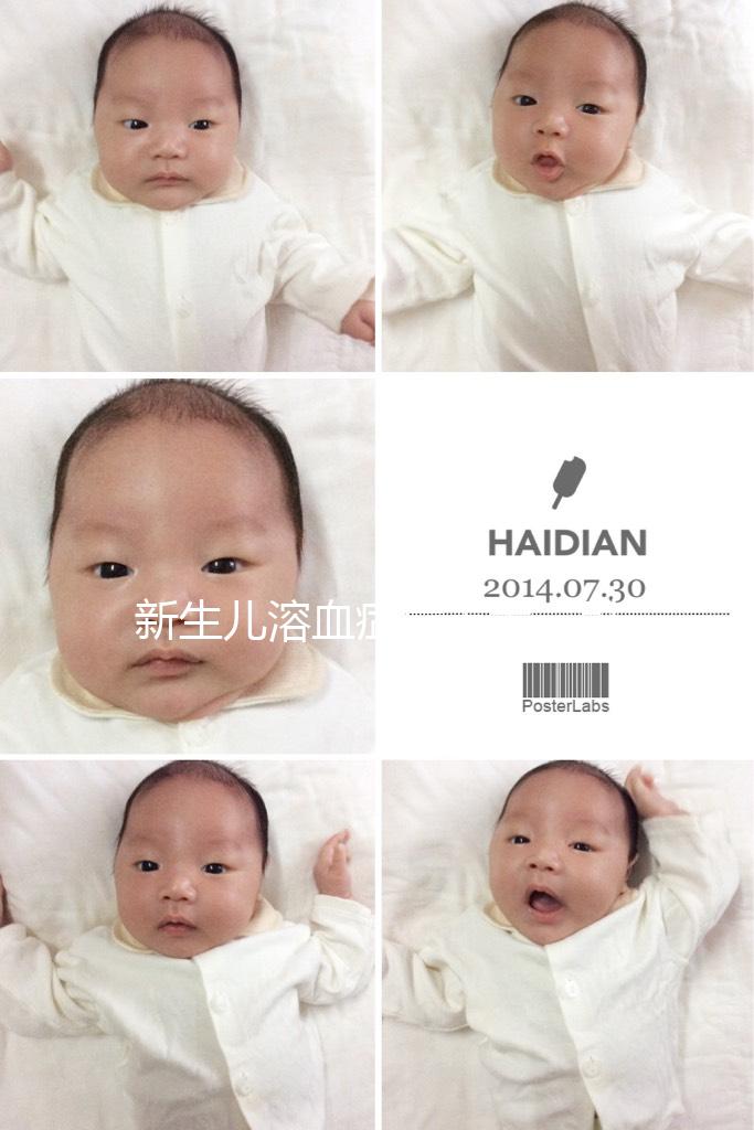 新生兒溶血癥危害大，引發膽紅素腦病可致神經后遺癥