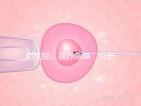 時(shí)間短、操作簡(jiǎn)單，分步驟解讀宮頸擴(kuò)張術(shù)全過(guò)程