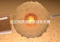 武漢同濟醫(yī)院采精手術費用分析，顯微采精也可報銷