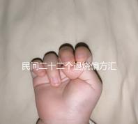 民間二十二個退燒偏方匯總,生雞蛋清、生姜放腳底還有…