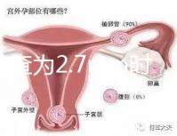 nt檢查為2.7mm時危險性莫亂猜，做完無創后才能確定